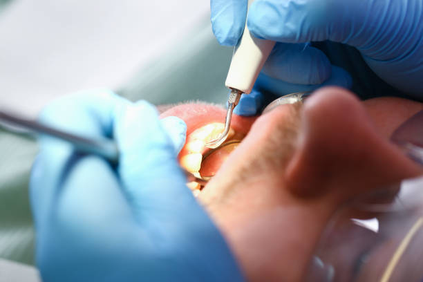 Best Emergency Wisdom Teeth Removal in Minden, NE